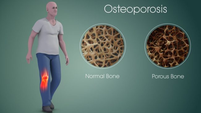 osteoporosis_1610692813